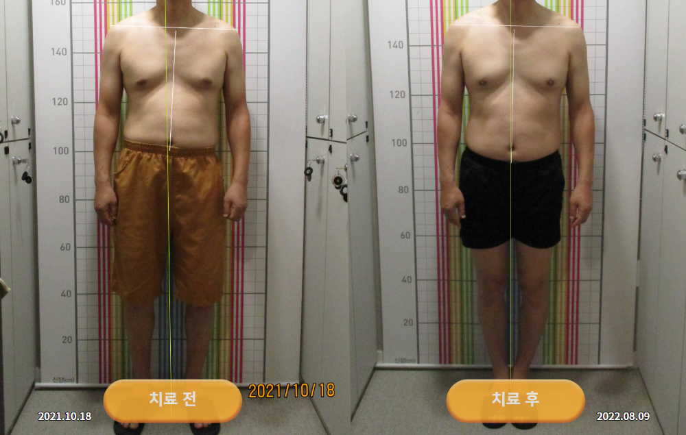 키가 커서 자세가 안 좋다보니 거북목과 안면비대칭이 심하던 40대 남성분 바로선치료 사진 4