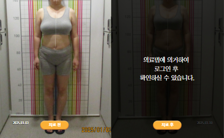 바로선치료 [30대 여성] 안면비대칭