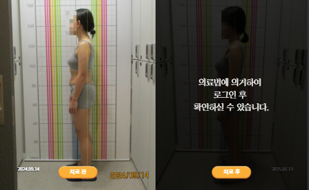 바로선치료 [20대 여성] 안면비대칭