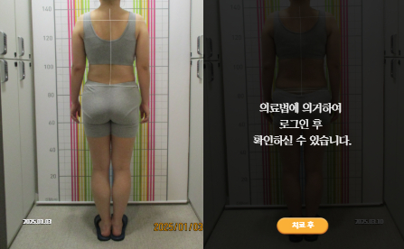 바로선치료 [30대 여성] 안면비대칭