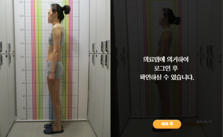 바로선치료 [20대 여성] 안면비대칭