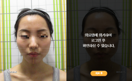 바로선치료 [20대 여성] 안면비대칭