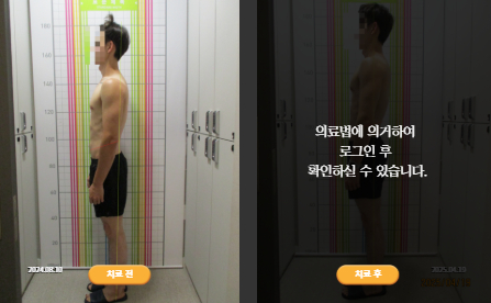 바로선치료 [20대 남성] 안면비대칭