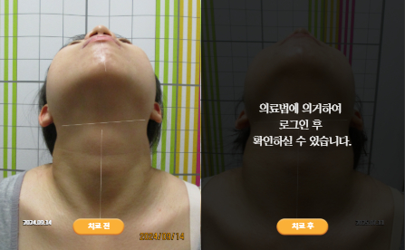 바로선치료 [20대 여성] 턱관절