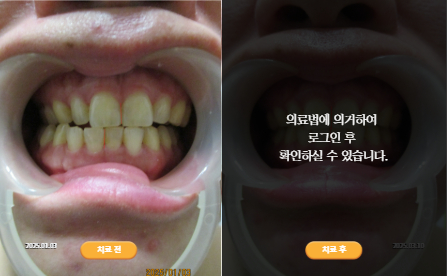 바로선치료 [30대 여성] 턱관절
