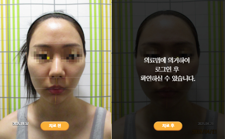 바로선치료 [20대 여성] 턱관절