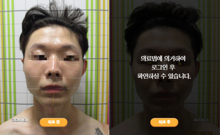 바로선치료 [20대 남성] 안면비대칭