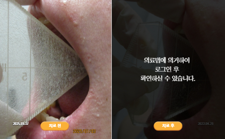 바로선치료 [30대 여성] 턱관절