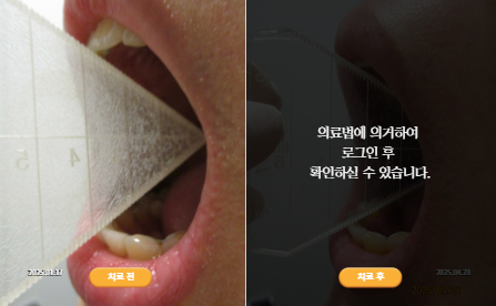 바로선치료 [20대 여성] 턱관절