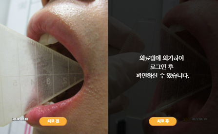 바로선치료 [20대 남성] 안면비대칭