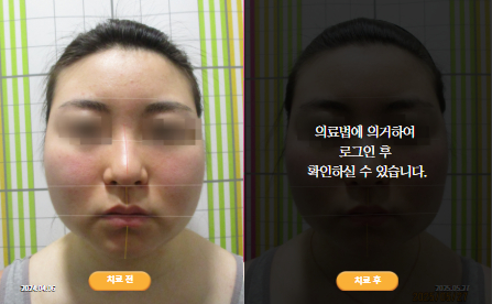바로선치료 [20대 여성] 안면비대칭