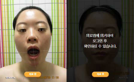 바로선치료 [30대 여성] 턱관절