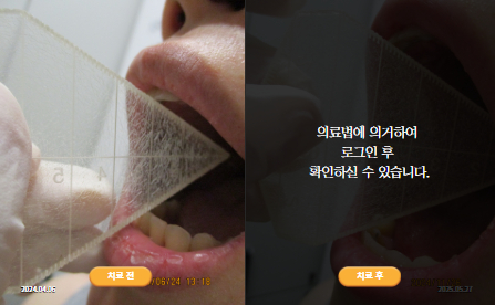바로선치료 [30대 여성] 턱관절