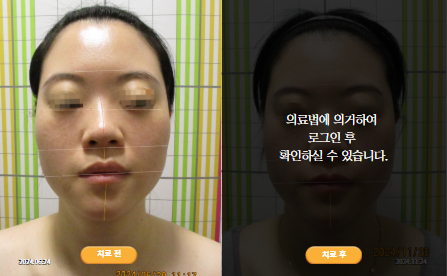 바로선치료 [30대 여성] 안면비대칭