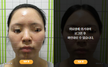 바로선치료 [20대 여성] 안면비대칭