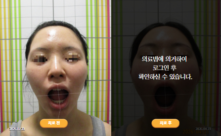 바로선치료 [20대 여성] 턱관절