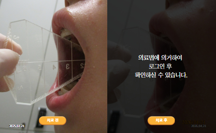 바로선치료 [20대 여성] 턱관절