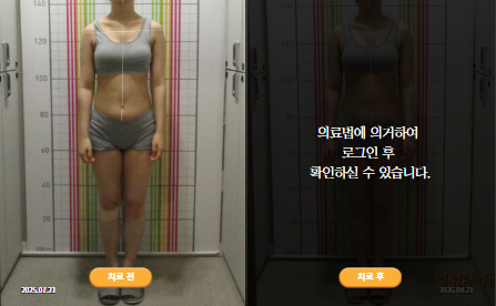 바로선치료 [20대 여성] 안면비대칭