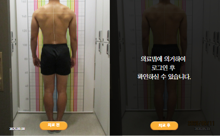바로선치료 [20대 남성] 안면비대칭