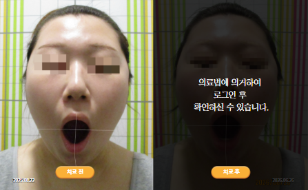 바로선치료 [20대 여성] 안면비대칭