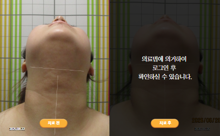 바로선치료 [20대 여성] 안면비대칭