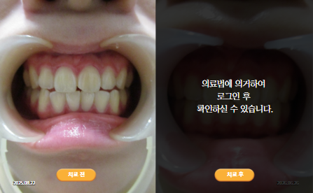 바로선치료 [20대 여성] 안면비대칭