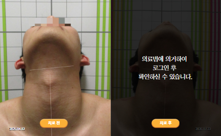 바로선치료 [20대 남성] 안면비대칭
