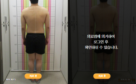 바로선치료 [20대 남성] 안면비대칭