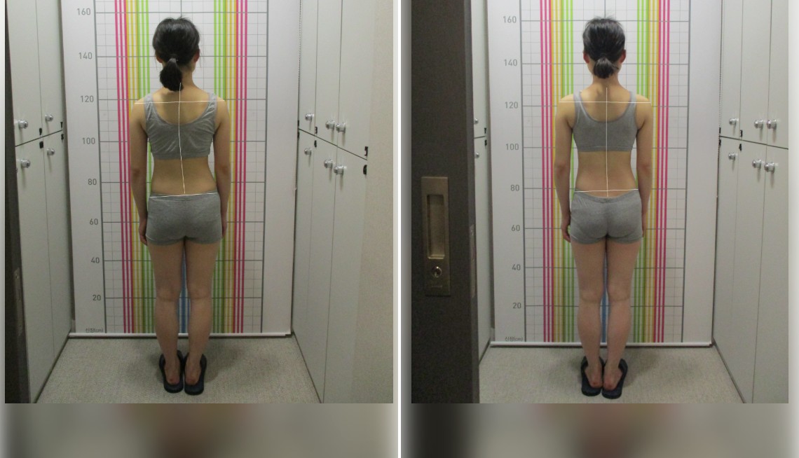 바로선치료 체형교정 치료 전후 비교 – 뒷모습 전신 자세 사례 1