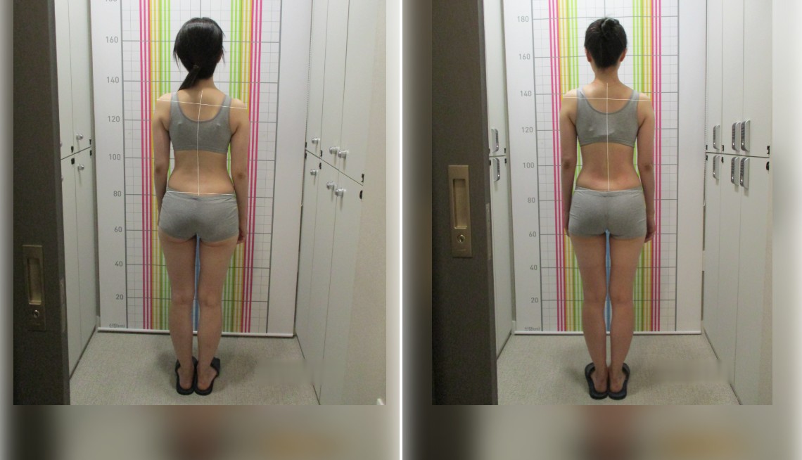 바로선치료 체형교정 치료 전후 비교 – 뒷모습 전신 자세 사례 2