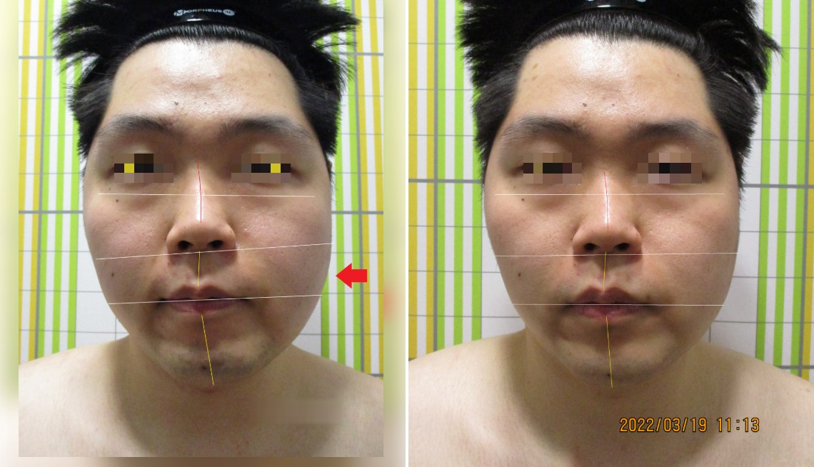 바로선치료 안면비대칭 리얼 스토리 – 치료 전후 정면 얼굴 비교 1