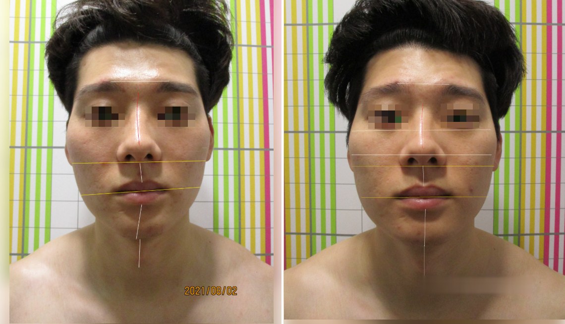 바로선치료 안면비대칭 리얼 스토리 – 치료 전후 정면 얼굴 비교 3