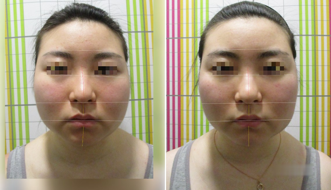 바로선치료 안면비대칭 리얼 스토리 – 치료 전후 정면 얼굴 비교 4