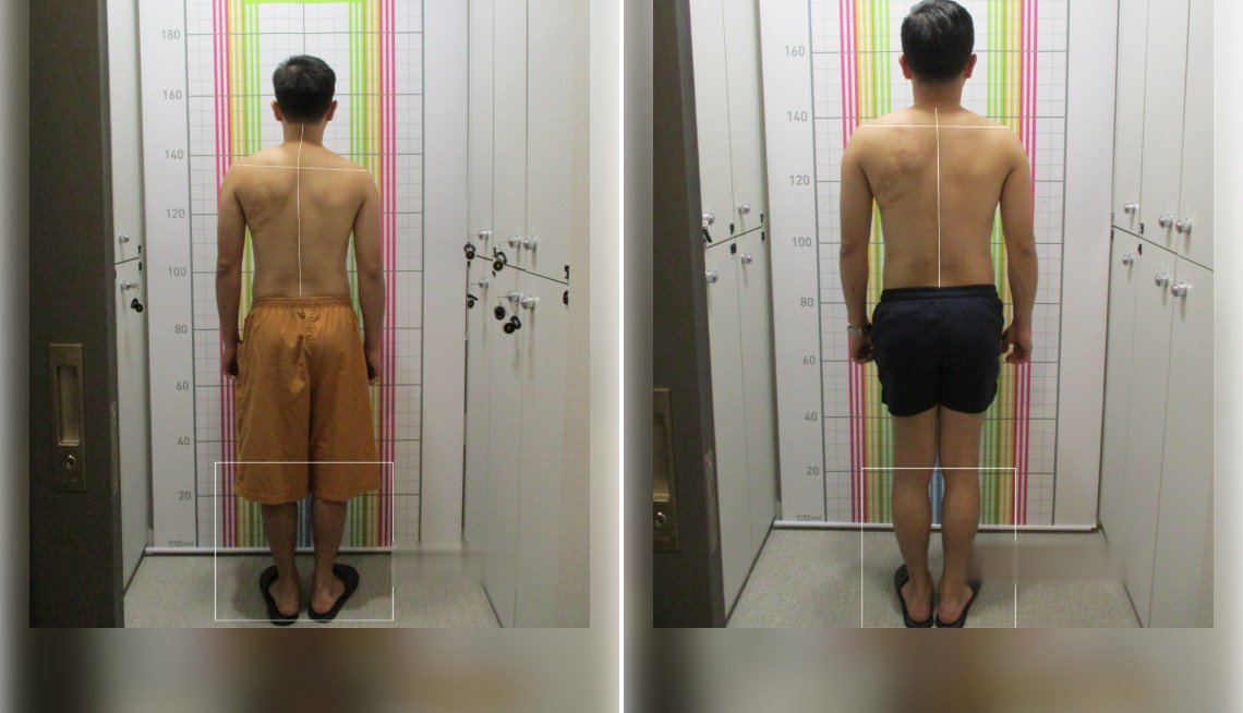 바로선치료 체형 중심축 리얼 스토리 – 치료 전후 뒷모습 자세 비교 1