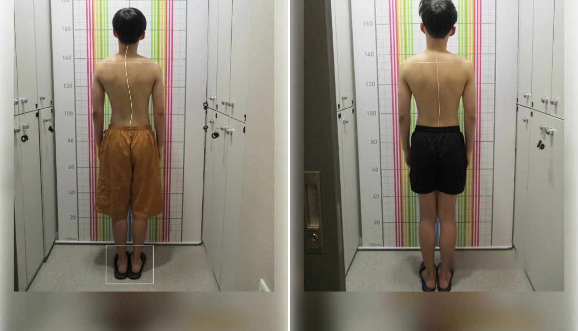 바로선치료 체형 중심축 리얼 스토리 – 치료 전후 뒷모습 자세 비교 2
