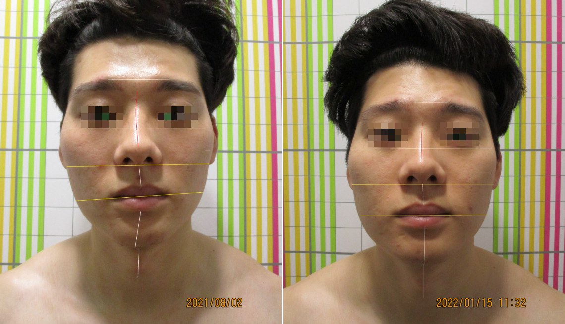 바로선치료 안면비대칭 치료 전후 비교 – 턱선·입꼬리 높이 개선 사례 2