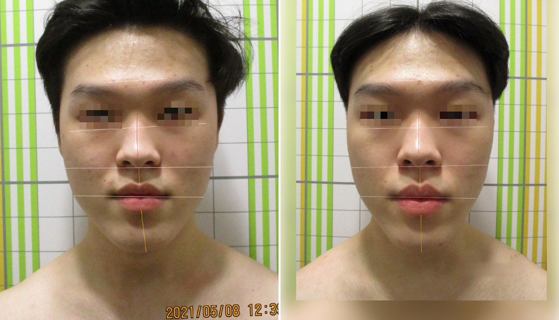 바로선치료 안면비대칭 치료 전후 비교 – 얼굴 좌우 균형 개선 사례 1