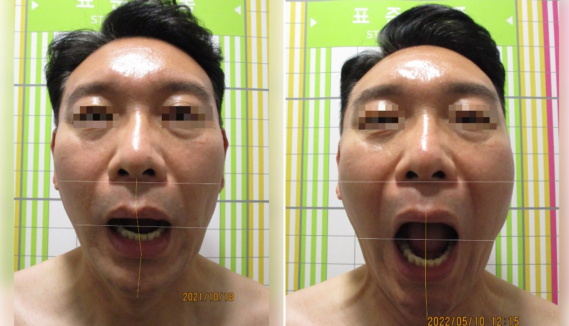 바로선치료 개구장애 치료 전후 비교 – 입 벌림 제한 개선 사례 1