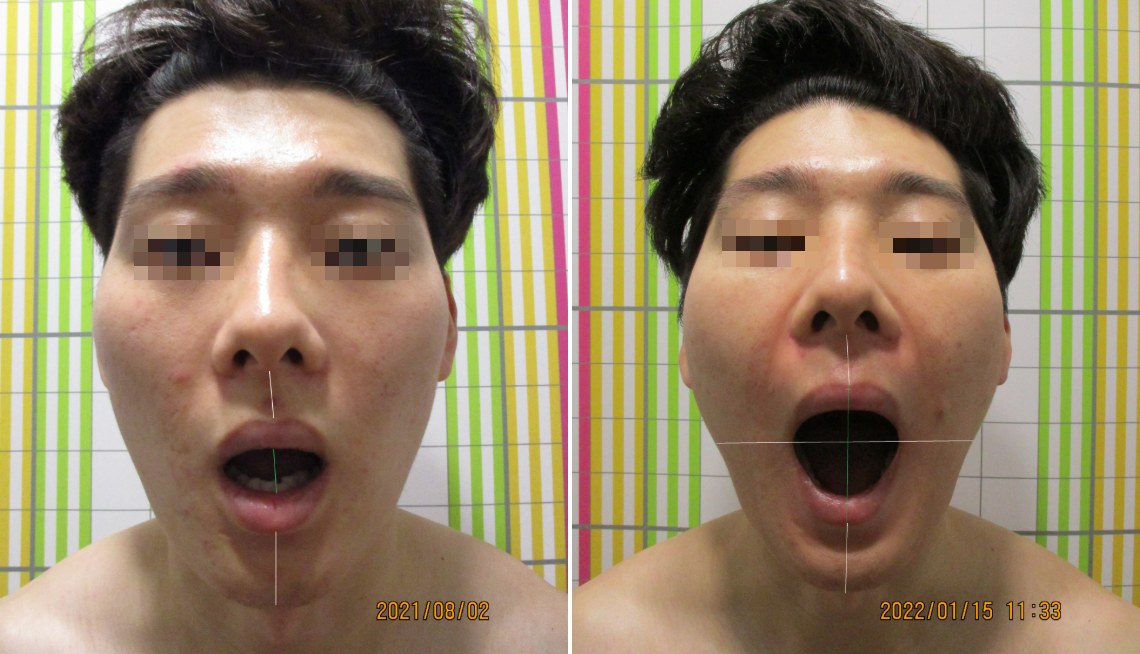바로선치료 개구장애 치료 전후 비교 – 입 벌림 제한 개선 사례 2