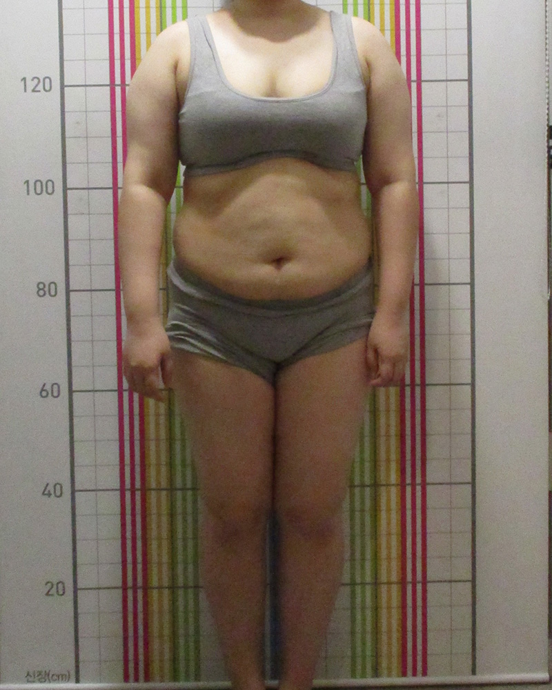 다이어트 클리닉 6개월 경과 치료 전 정면