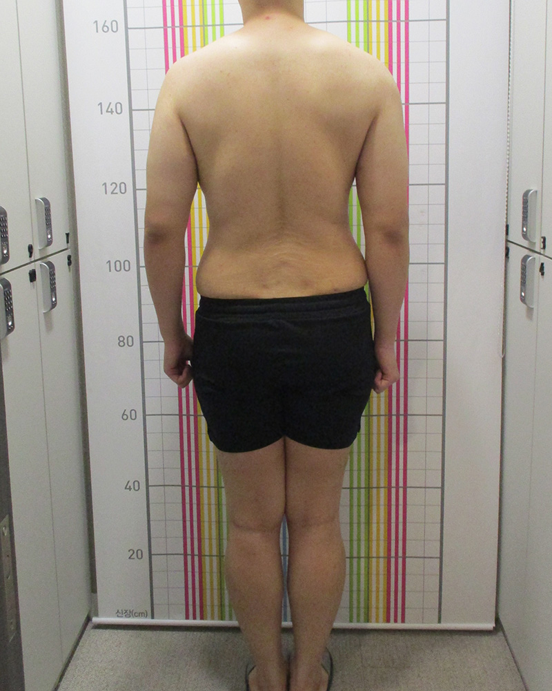 다이어트 클리닉 5개월 경과 치료 후 정면