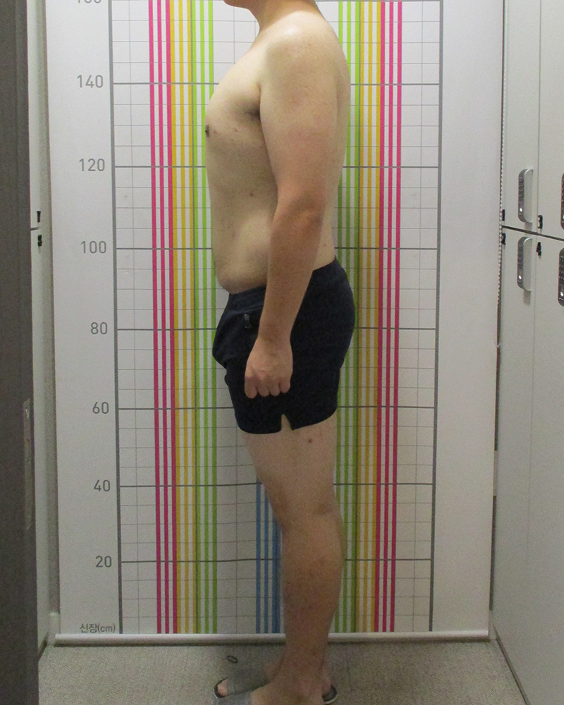 웰씬다이어트 5개월 경과 치료 후 정면