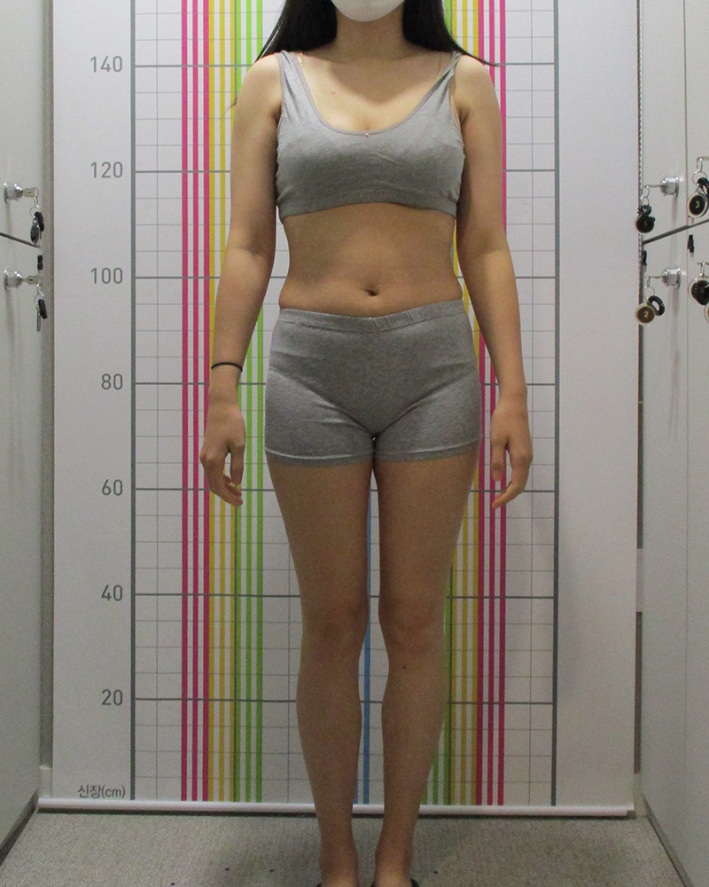 웰씬다이어트 5개월 경과 치료 후 정면