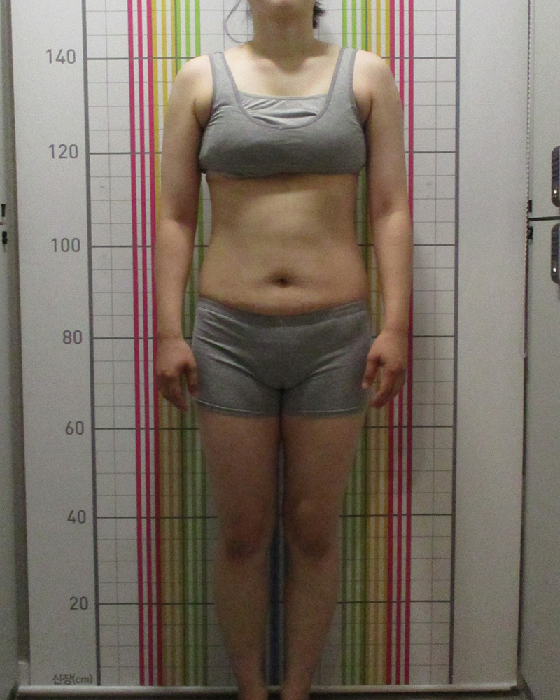 다이어트 클리닉 5개월 경과 치료 후 정면