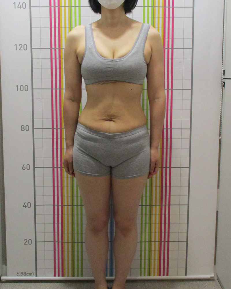 웰씬다이어트 6개월 경과 치료 후 정면