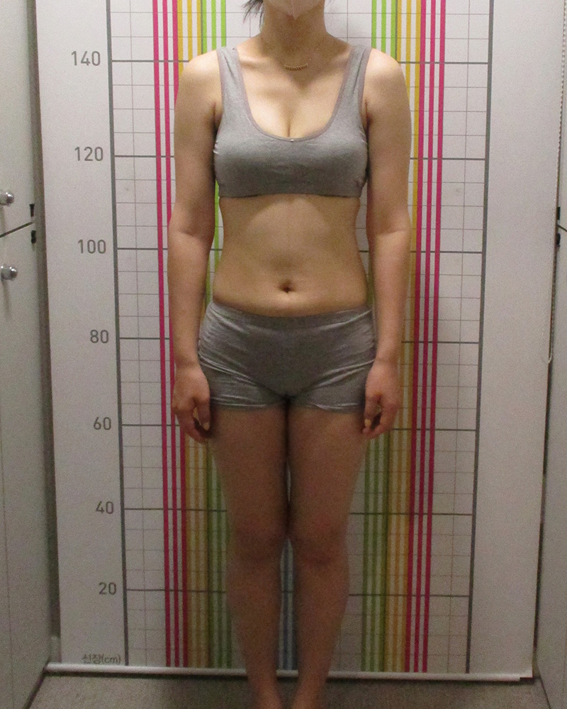 웰씬다이어트 3개월 경과 치료 후 정면