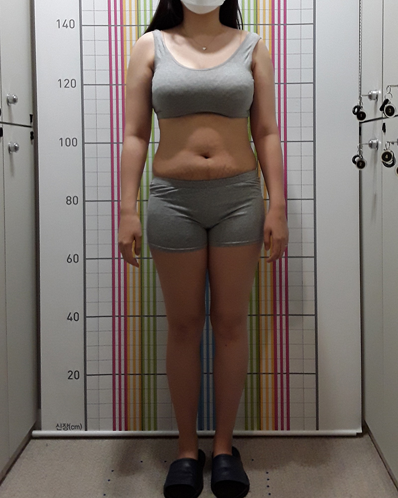 웰씬다이어트 5개월 경과 치료 전 정면
