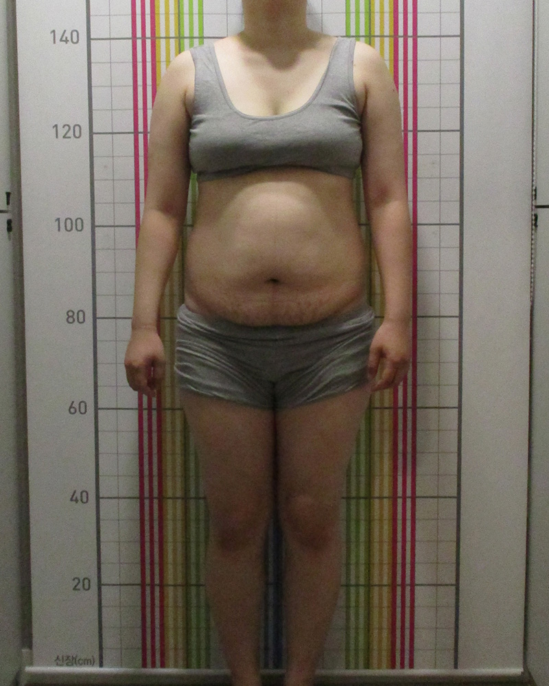다이어트 클리닉 5개월 경과 치료 전 정면