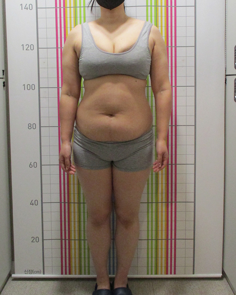 웰씬다이어트 6개월 경과 치료 전 정면
