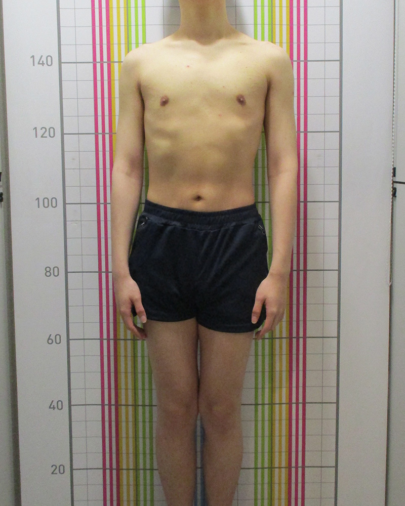 웰씬다이어트 14개월 경과 치료 후 정면